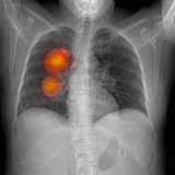 Heftig umkämpfter Markt für Krebsmittel