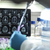 Erfolg für Alzheimer-Früherkennung von Roche