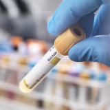 Roche lanciert neuartigen Hepatitis-Test